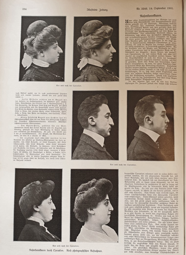 Vorher-/Nachher-Vergleich bei Nasenkorrekturen vor 120 Jahren – Xecutives.net berichtet aus einem Artikel in der Illustrierte Zeitung vom 6.Juli 1905